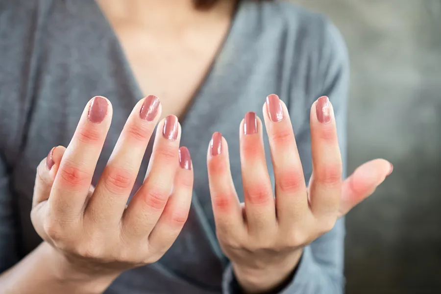 Lupus-Clinic A close-up of a woman in a gray shirt's hands with red irritation on the knuckles who needs Lupus treatment from Dr. David Lans in New Rochelle.