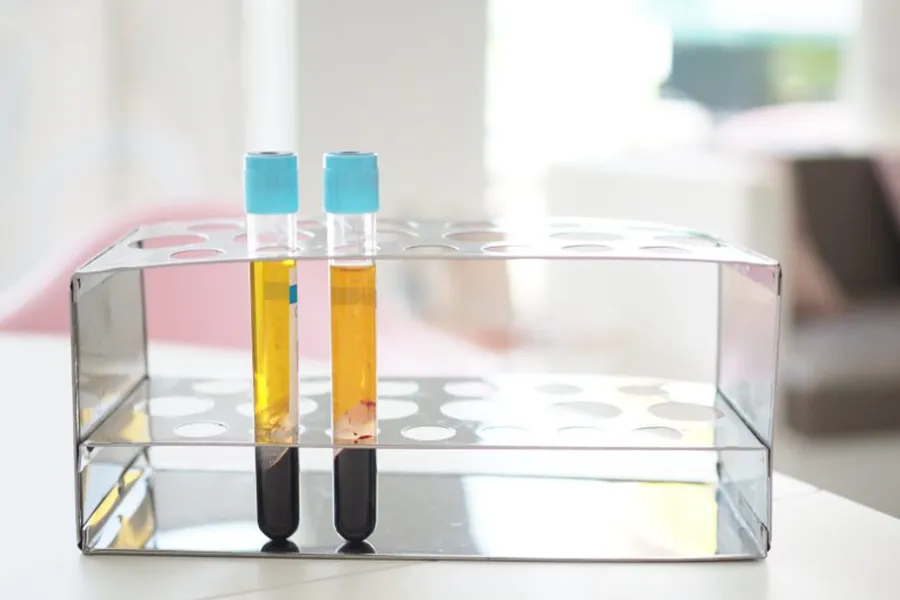 PRP-Platelet-Rich-Plasma-Therapy-Blood-Tube-Gel-for-Face-and-Hair-Treatment-800×533 Blog by Integrative Medicine Specialist, Dr. Lans in New Rochelle New York
