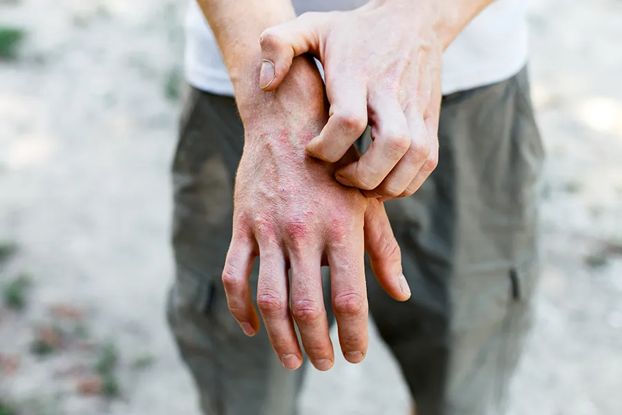 Psoriasis-Clinic Close-up of a man scratching his hands while experiencing Psoriasis. Get care for Psoriasis from Dr. David Lans in New Rochelle.