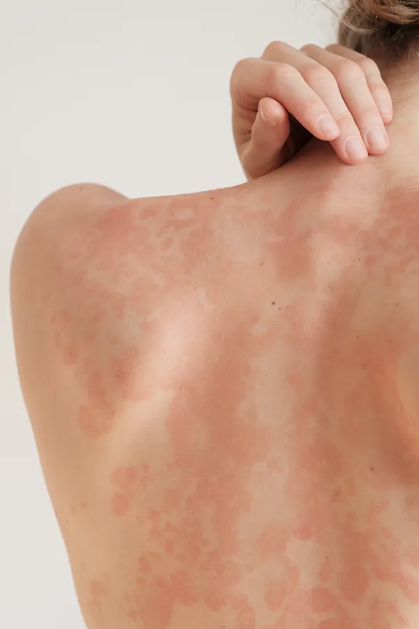 Psoriasis-Treatment The back and shoulder of a woman experiencing Psoriasis. Get treatment for Psoriasis from Dr. David Lans in New Rochelle.