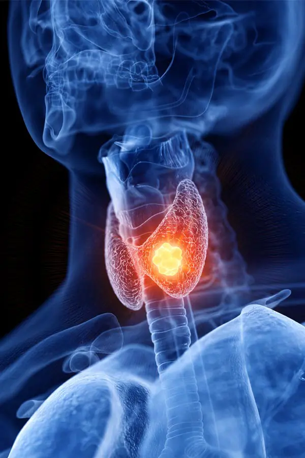 Thyroid-Imbalance-Treatment A 3D illustration of an x-ray of a human neck, highlighting the thyroid. Get help with thyroid imbalance from Dr. David Lans in New Rochelle.