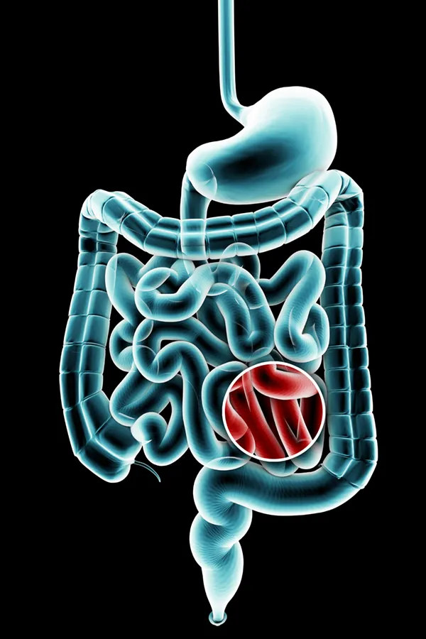 Ulcerative-Colitis-Treatment 3D illustration of the digestive system in blue with a red circle highlighting areas of discomfort. Get treatment for Ulcerative Colitis from Dr. David Lans in New Rochelle.